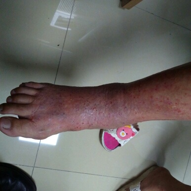 楼梯的时候不小心扭到右脚,因为想快点痊愈,就在别人的建议下外敷中药