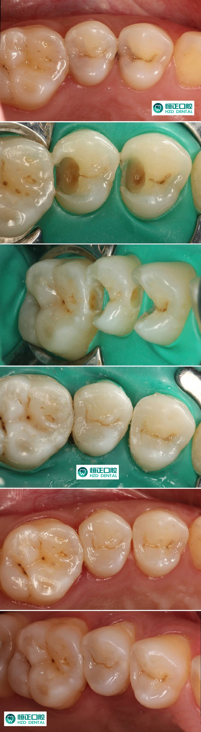 病例3:患者去潔牙醫生告知有齲齒,此類齲齒是難以自我發覺的.