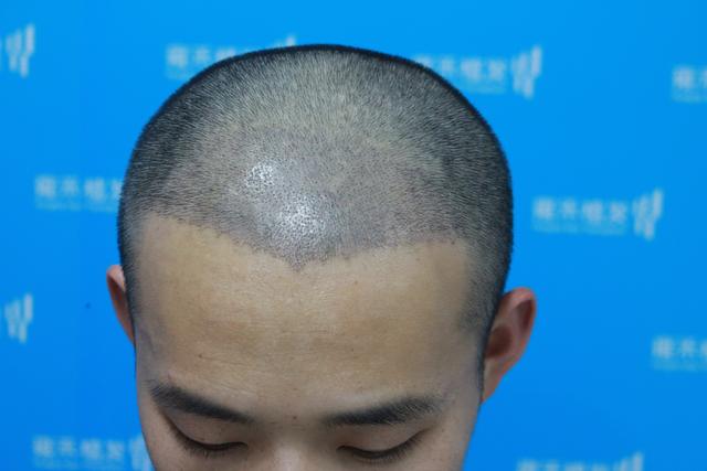 正常人的发际线图片,正常人发际线图片,发际线正常图片_大山谷图库