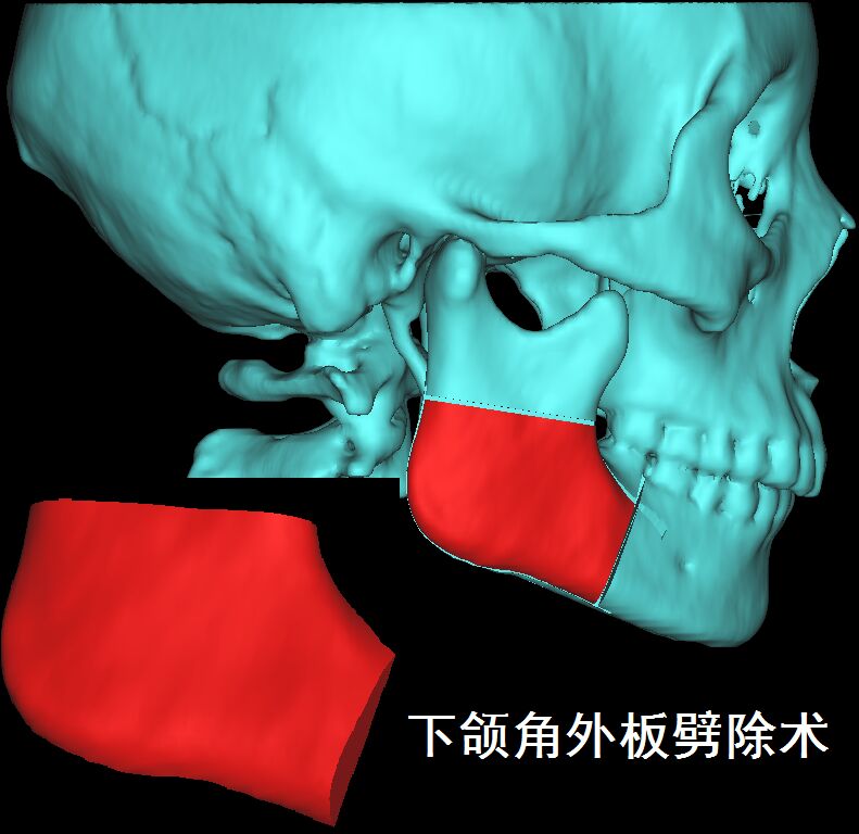 下颌角外板劈除