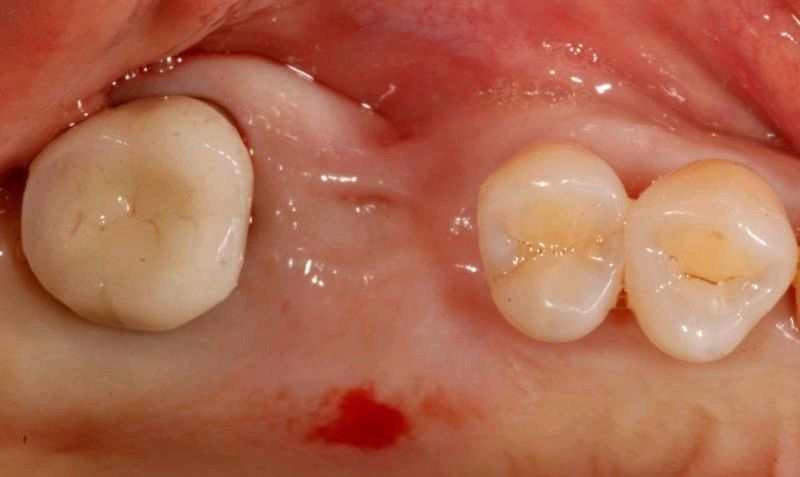 碧兰麻局部阻滞麻醉引起组织坏死