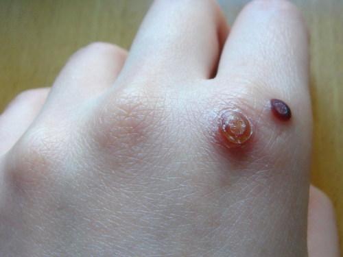 身上长的瘊子分公母吗