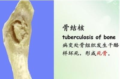 一口气读懂骨结核病关于骨结核你想知道的都在这