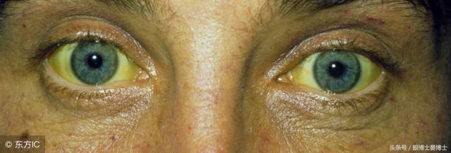 眼睛的这些变化可能预示着哪些疾病?