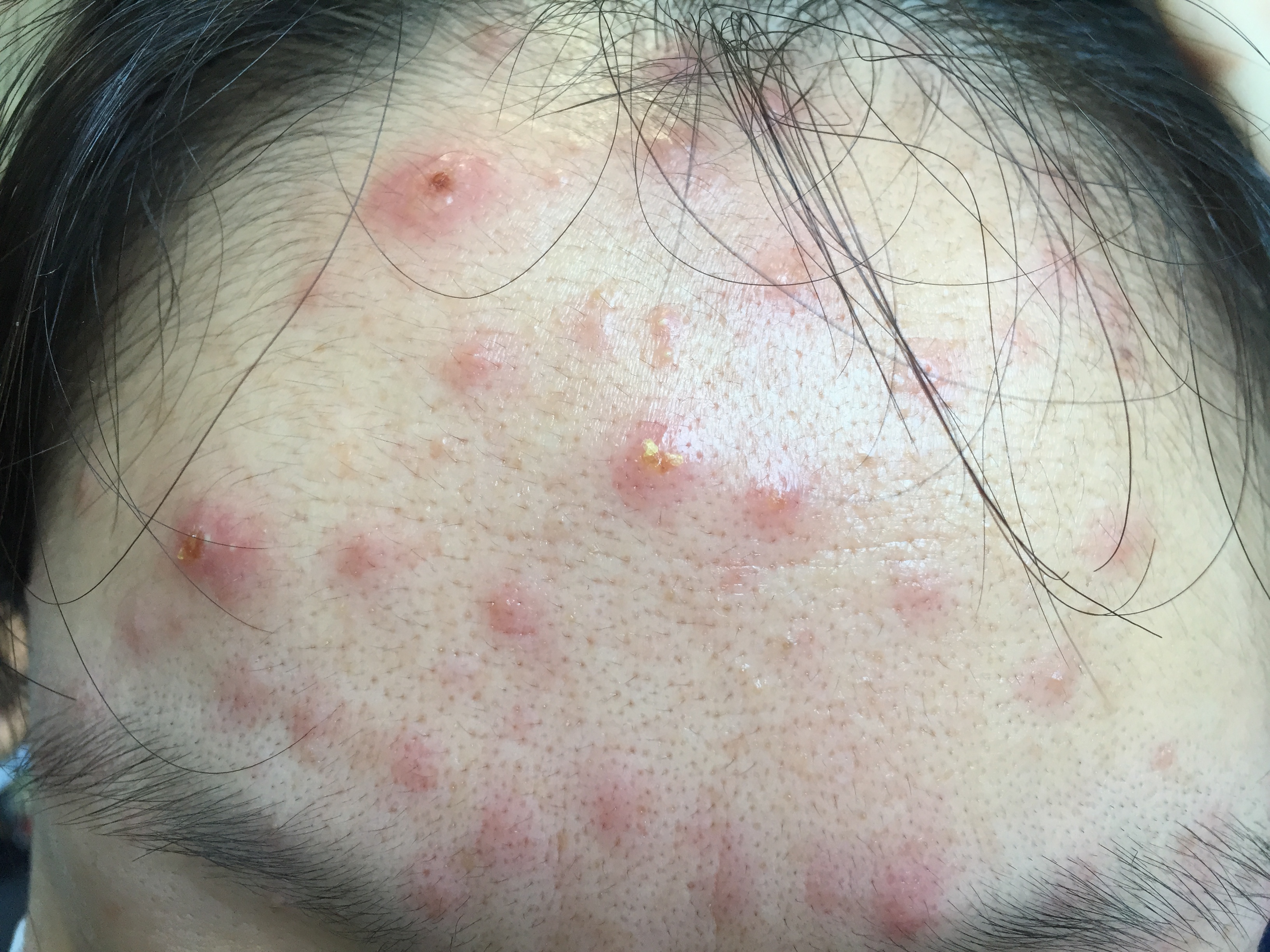 成人也是可以被传染水痘的就诊请一定记得戴口罩