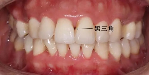 正畸黑三角,深圳牙齿矫正刘铃医生.jpeg