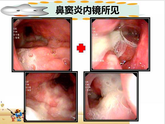 儿童鼻鼻窦炎发病的发病率比较高