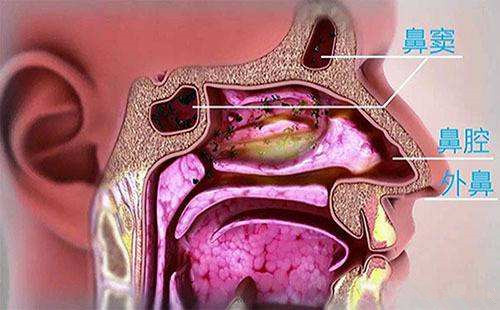 息肉,多导致双侧嗅觉下降,鼻中隔偏曲,鼻乳头状瘤和鼻腔肿瘤则多为单