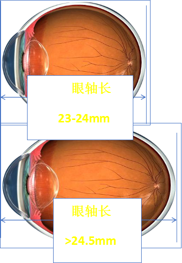 絕大部分真性近視是指眼睛長度(眼軸)過長,導致焦點無法成像在視網膜