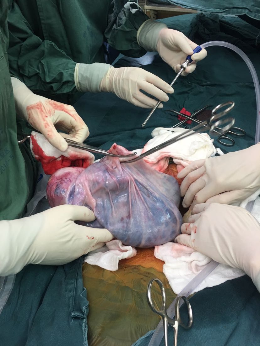 巨大盆腔包块—-卵巢癌