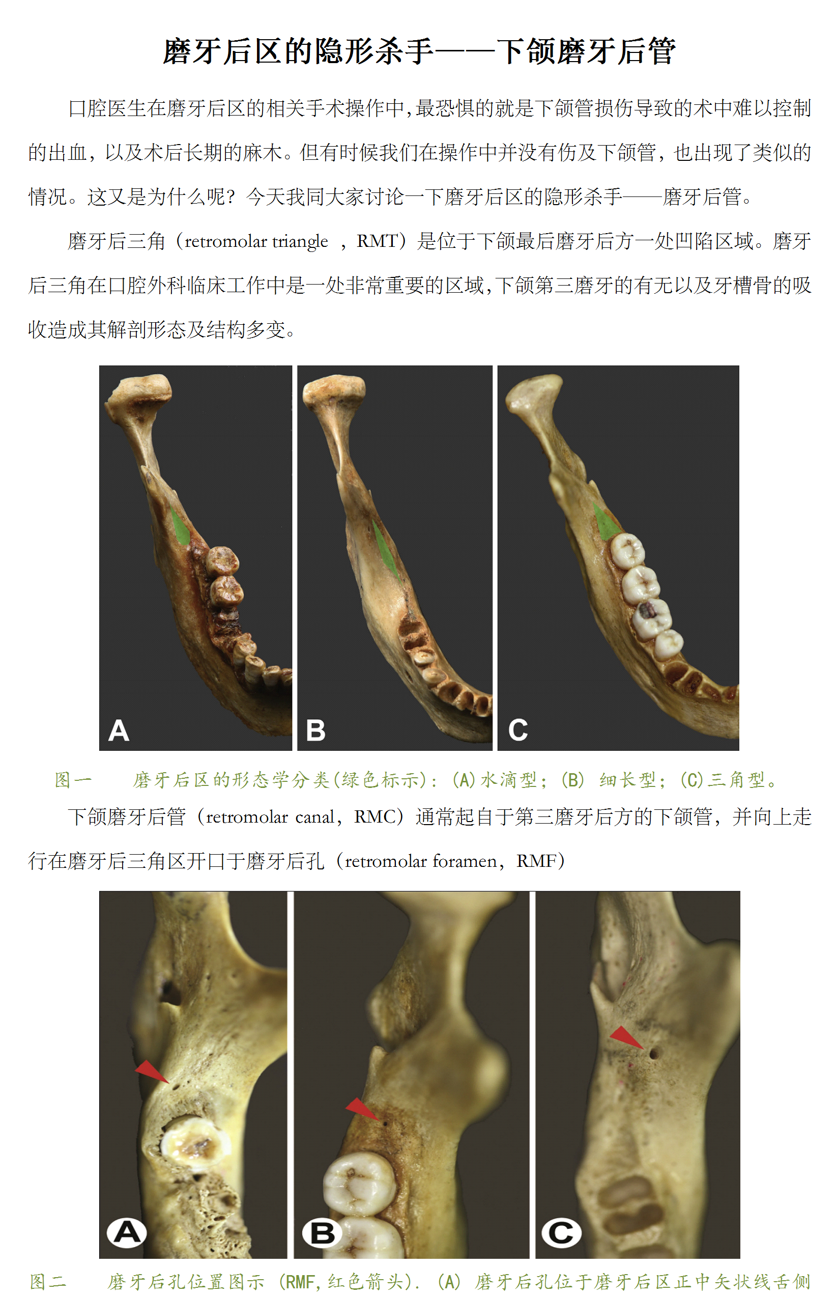磨牙后区的隐形杀手下颌磨牙后管