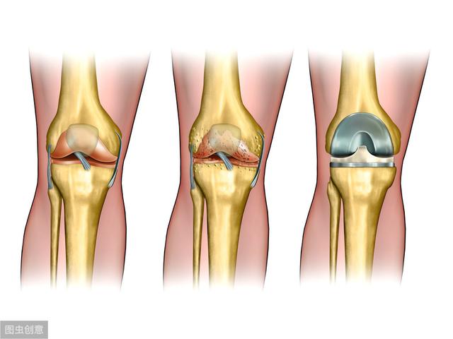 经常膝盖痛要小心骨关节炎!