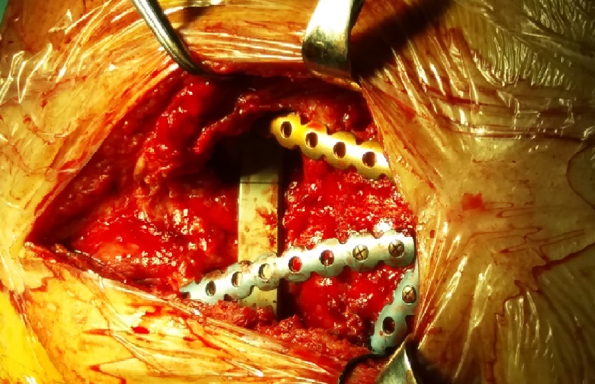 再创奇迹:重度复杂胸廓畸形手术今天获得成功