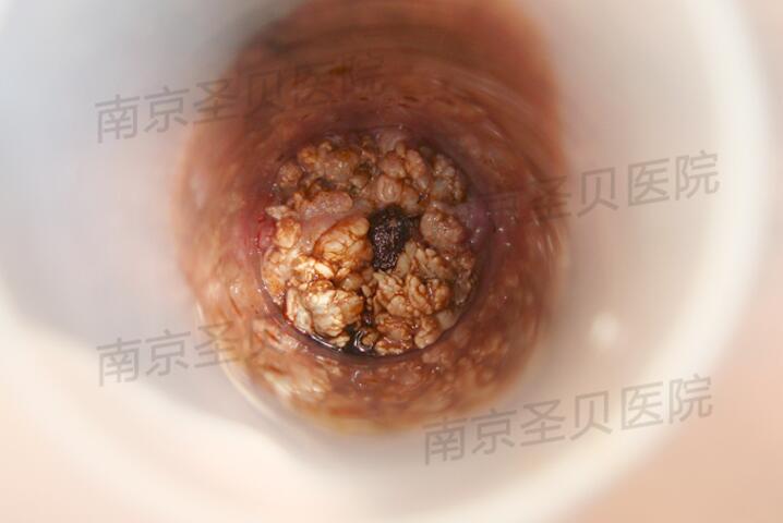 因为这些地方利于它的生存,导致尖锐湿疣病变的病原体是hpv病毒,而