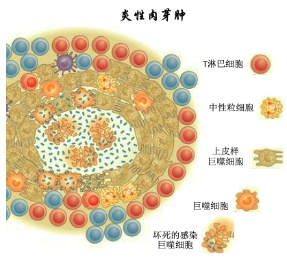 梅毒螺旋体,真菌,寄生虫等)或异物而形成的,具有特殊结构的细胞结节