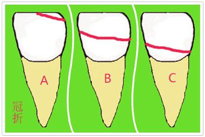 牙齿"骨折"该怎么办?-赵宇飞主治医师-爱问医生