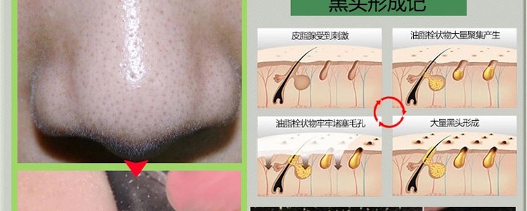 黑头跟粉刺有什么区别?