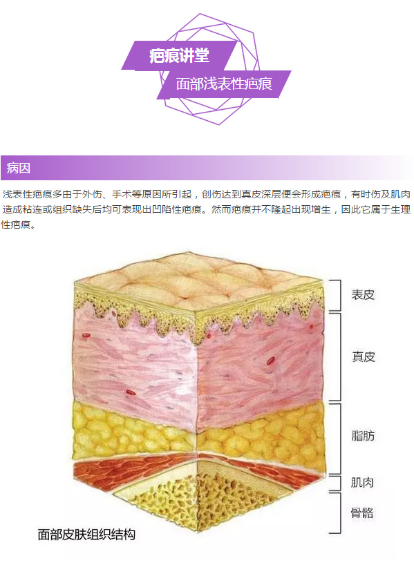 陈立彬疤痕讲堂面部浅表性疤痕