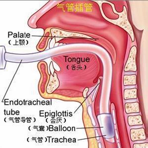 气管插管的病人还能活吗?