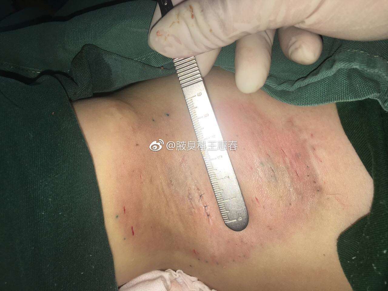 根除术扩大范围依据是术中直视下判断,非直视下做不到,盲视手术意义不