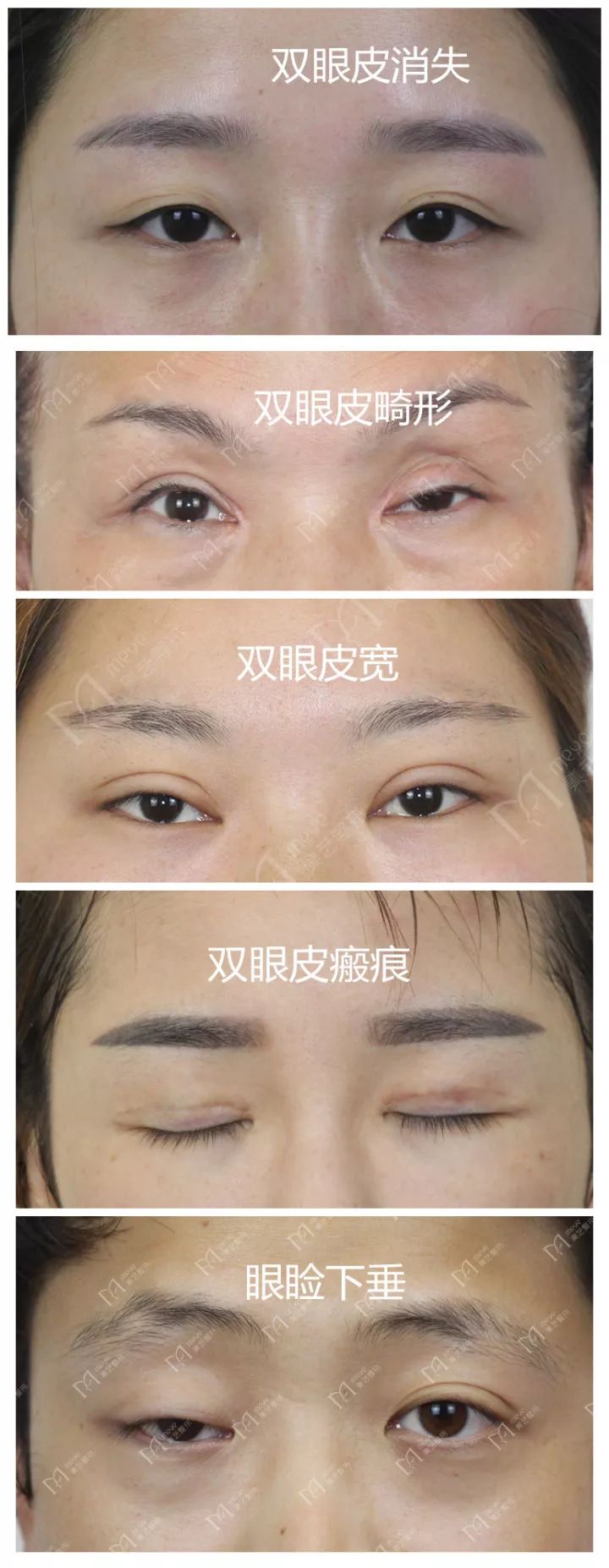 双眼皮修复是不是要把里面的缝线全部取出来呢 孔宇主任医师 爱问医生