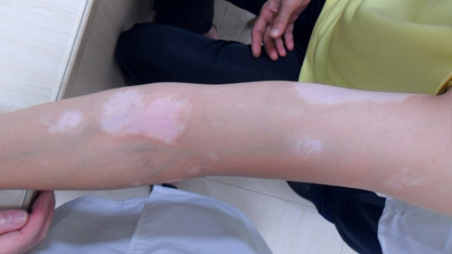 白癜风白斑处痒是怎么回事-黄丽主治医师-爱问医生