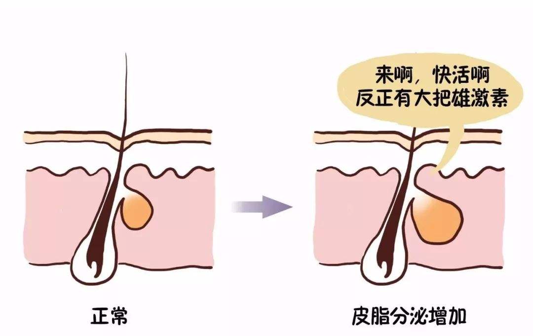 皮脂分泌过多是痤疮发生的基本病理基础】