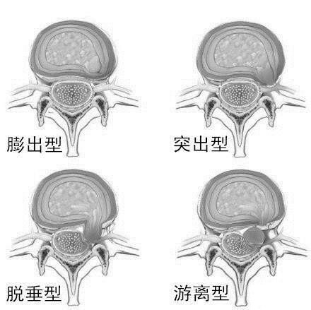 腰椎间盘突出的原理是什么?自身会吸收变小萎缩吗?医生为你揭秘_姚京