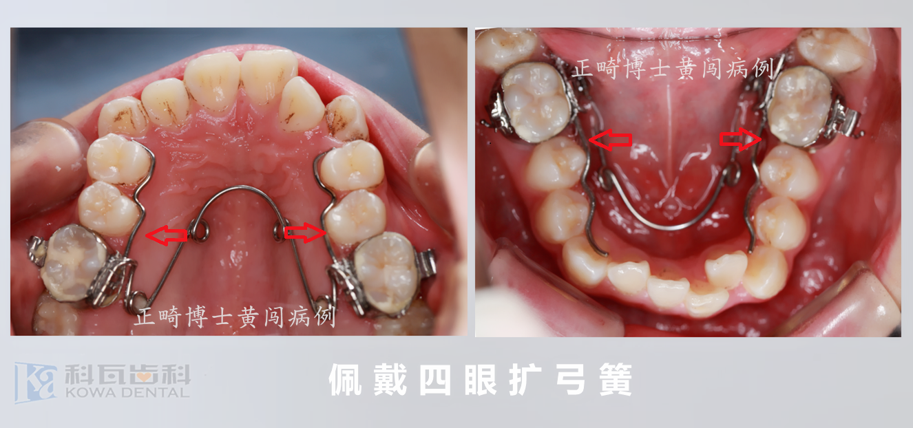 四眼扩弓簧不拔牙三个月解除牙列重度拥挤