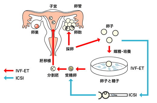 美国试管婴儿专家讲解-ivf 过程之取卵