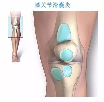 致病原因可能是鍛鍊,受傷,過度使用或者感染.