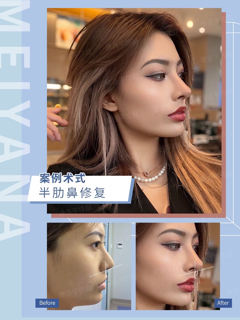 歪鼻矫正好多人喜欢的鼻型模板