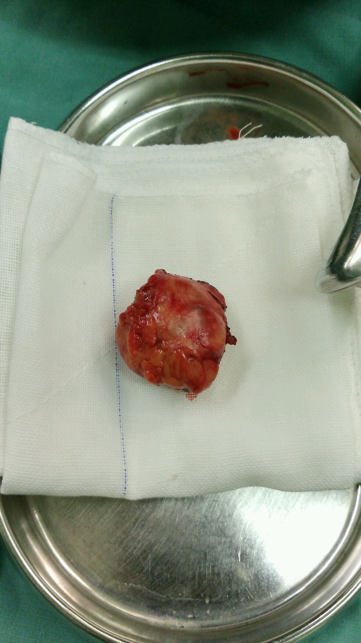 右肾癌开放右肾部分切除术20161208诊间日记