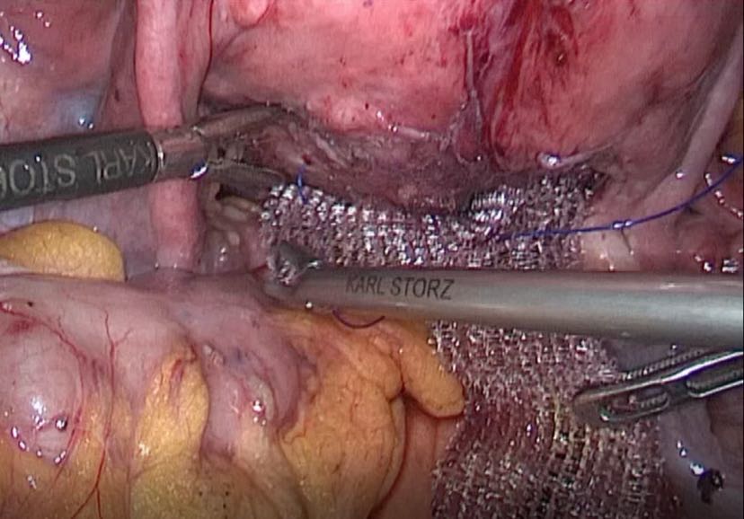腹腔镜子宫悬吊术步骤图片