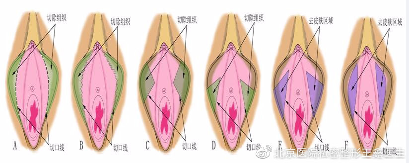 女性私密整形:小阴唇整形手术之热点问答