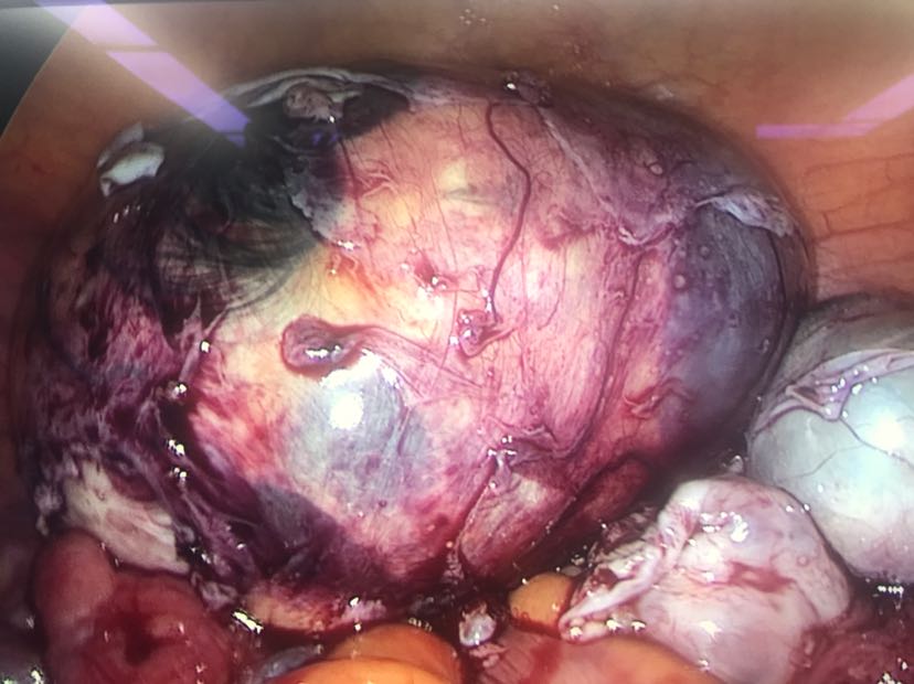 附件畸胎瘤图片