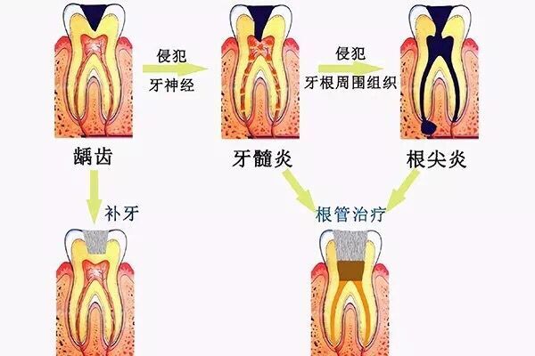 浅龋中龋深龋的鉴别,浅龋中龋深龋鉴别,浅龋中龋深龋_大山谷图库