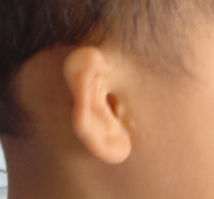 新生儿耳甲腔凸起图图片