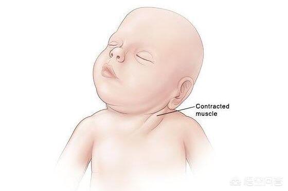 新生儿胸锁乳突肌包块图片