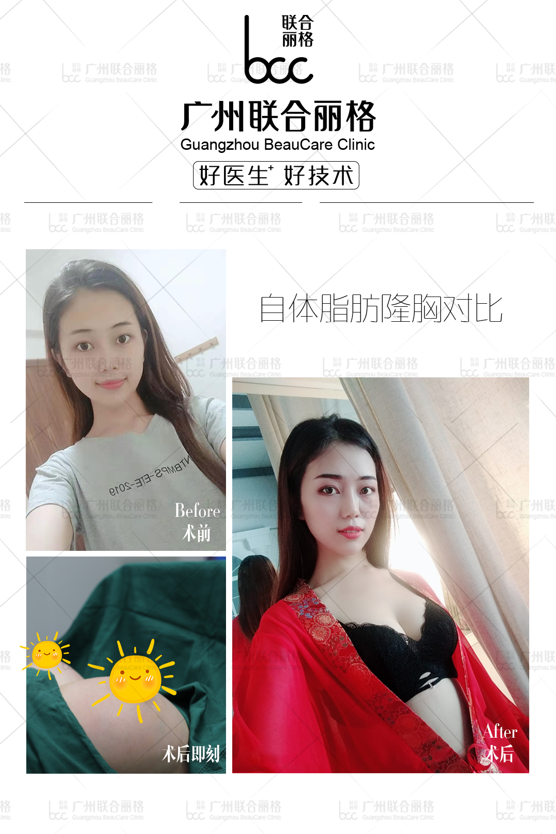 隆胸后 胸比头大？这样的整容你能接受吗？ - 知乎