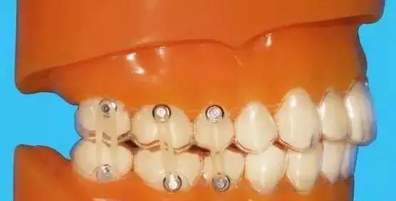 关于牙套上橡皮筋的n个秘密