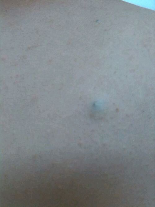 粉瘤 是什么 如何处理 怎么预防 邱俏峰主治医师 爱问医生