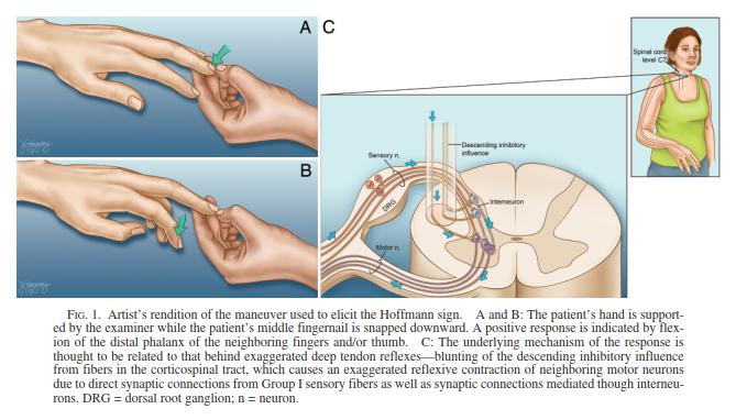 神经科的一项特殊查体-----霍夫曼征与颈椎间盘突出症