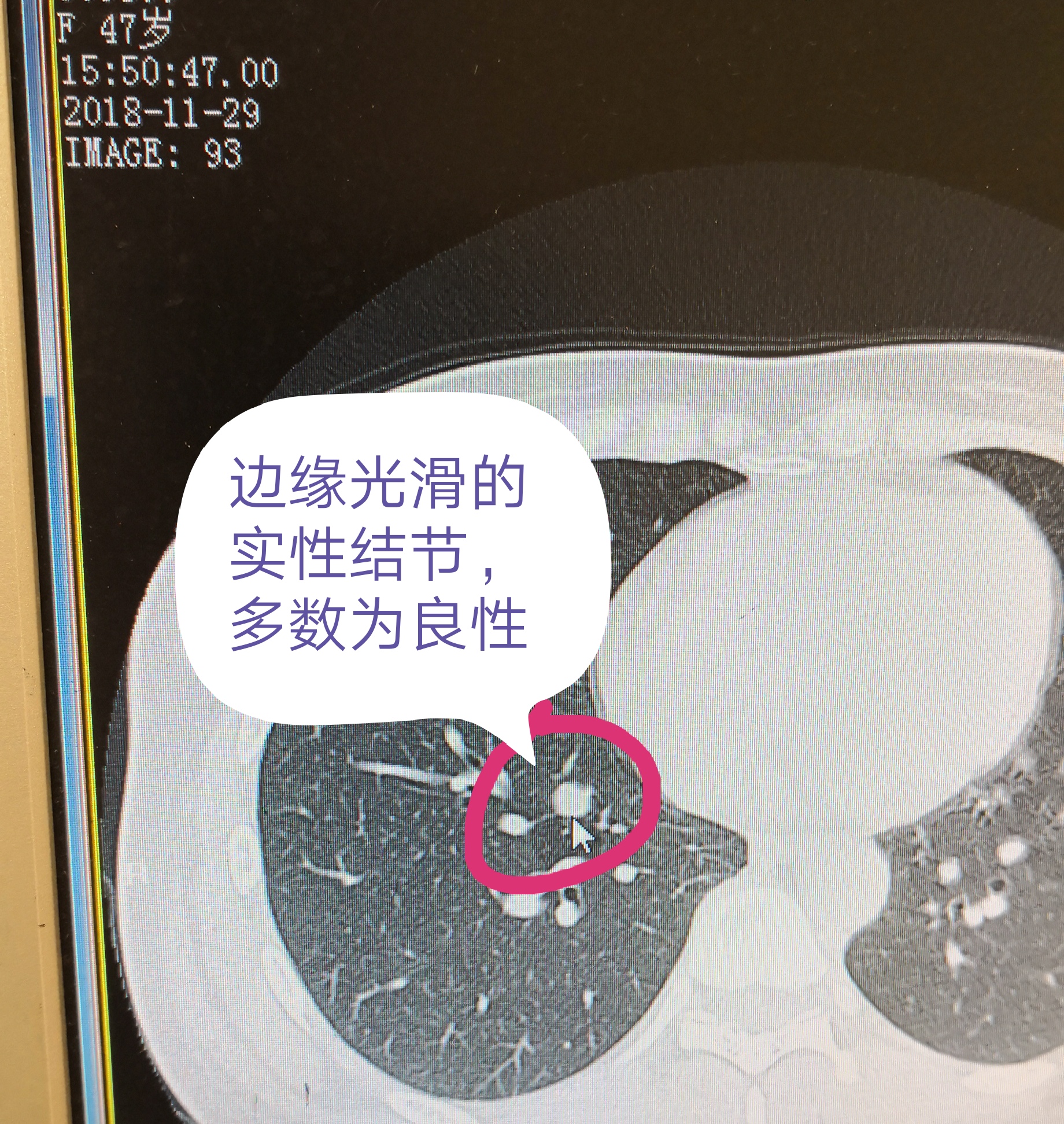 我两边都有肺小结节,我爸爸就是肺癌去世的,我好怕!