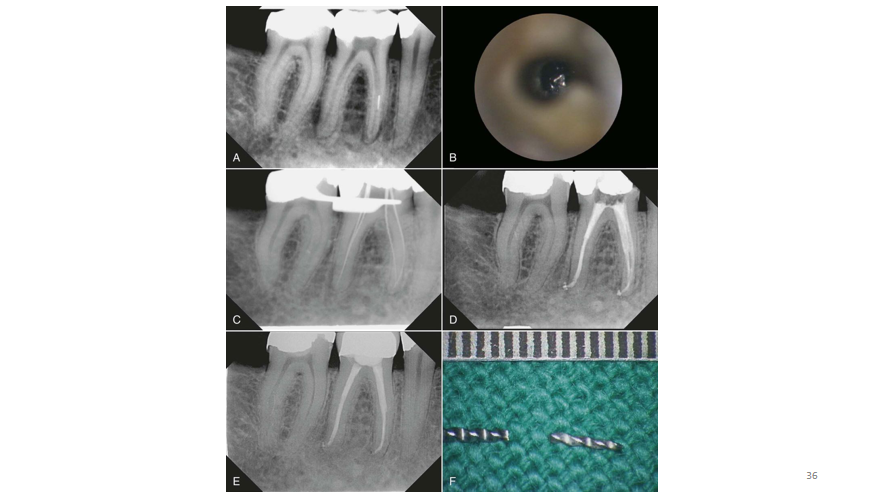根管治疗并发症器械折断