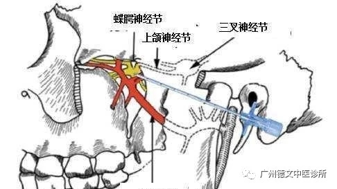 蝶腭神经针刺术介绍:慢性鼻炎,过敏性鼻炎,中西医结合一针见效