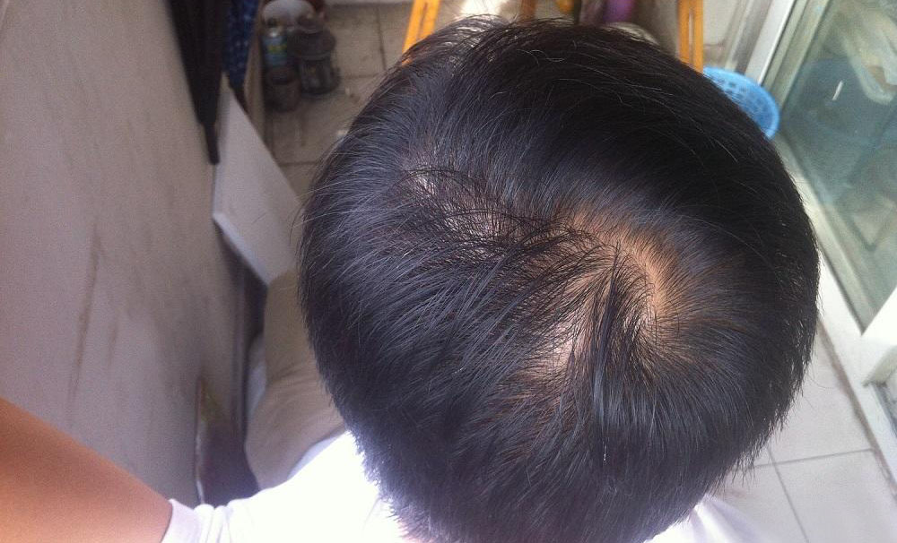 男性脱发治疗最好方法 拒绝寸草不生!