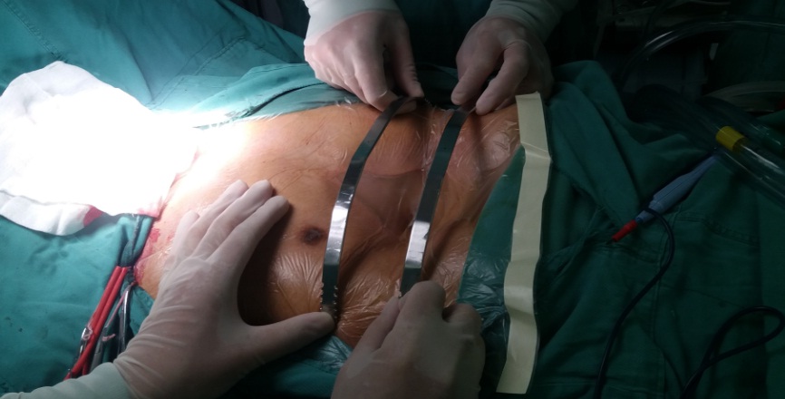 wang手术伟大实战成人重度胸廓畸形合并重度心脏病一期手术