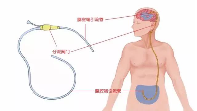 首先,无论哪种原因引起的脑积水都可以采用分流手术的方式,通俗的讲