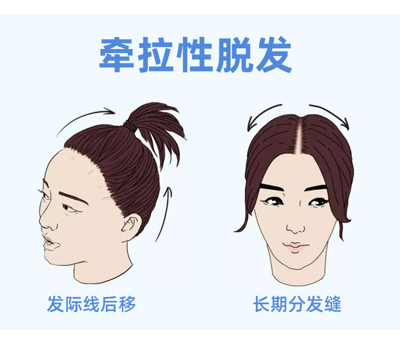 常见的脱发类型有哪些应该怎样治疗